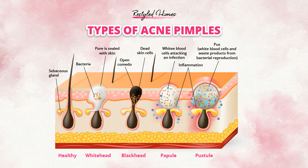 Types of pimples